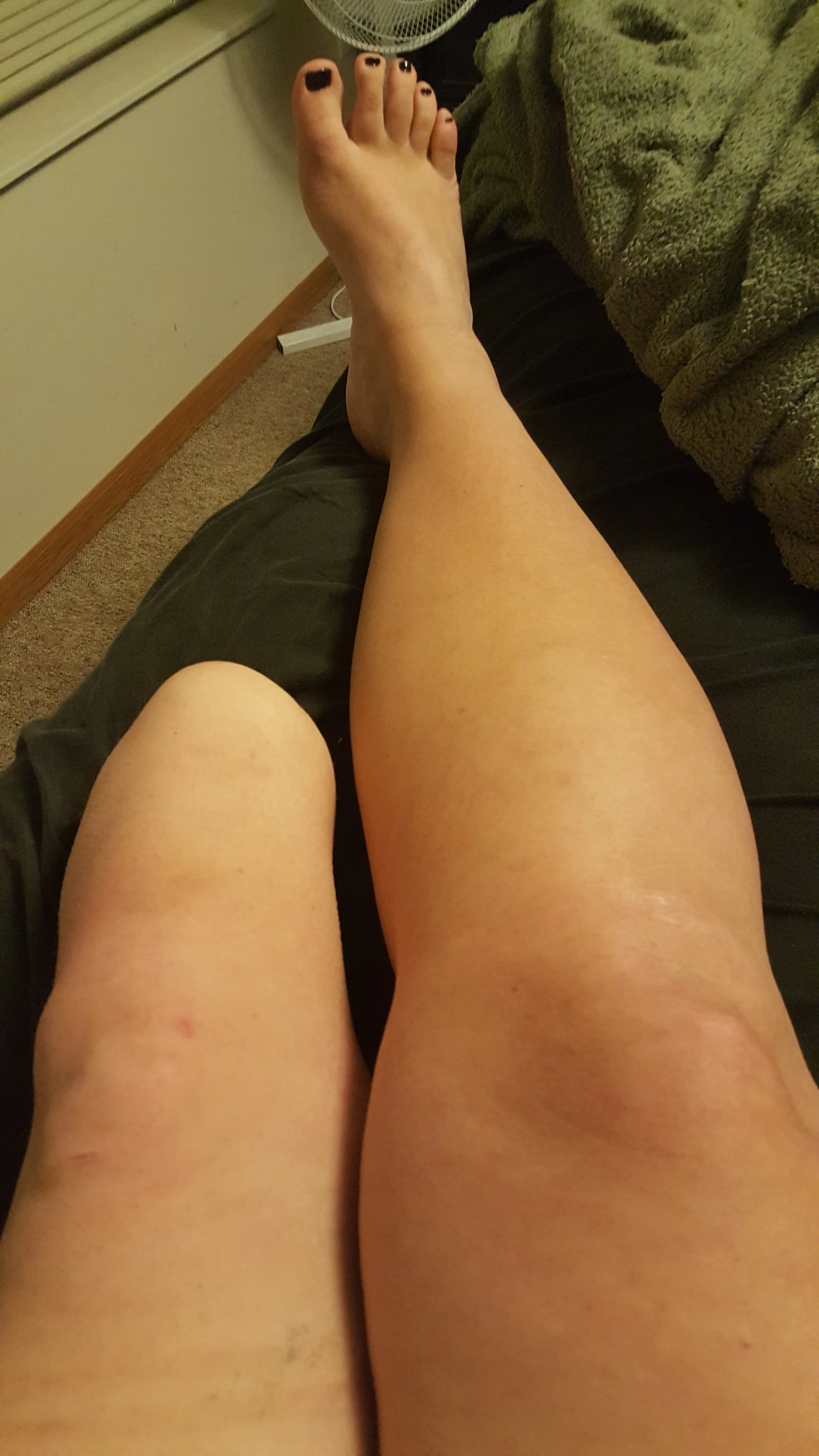 AmputeeAsh OnlyFans leaked - amputeeash nude pics and videos free