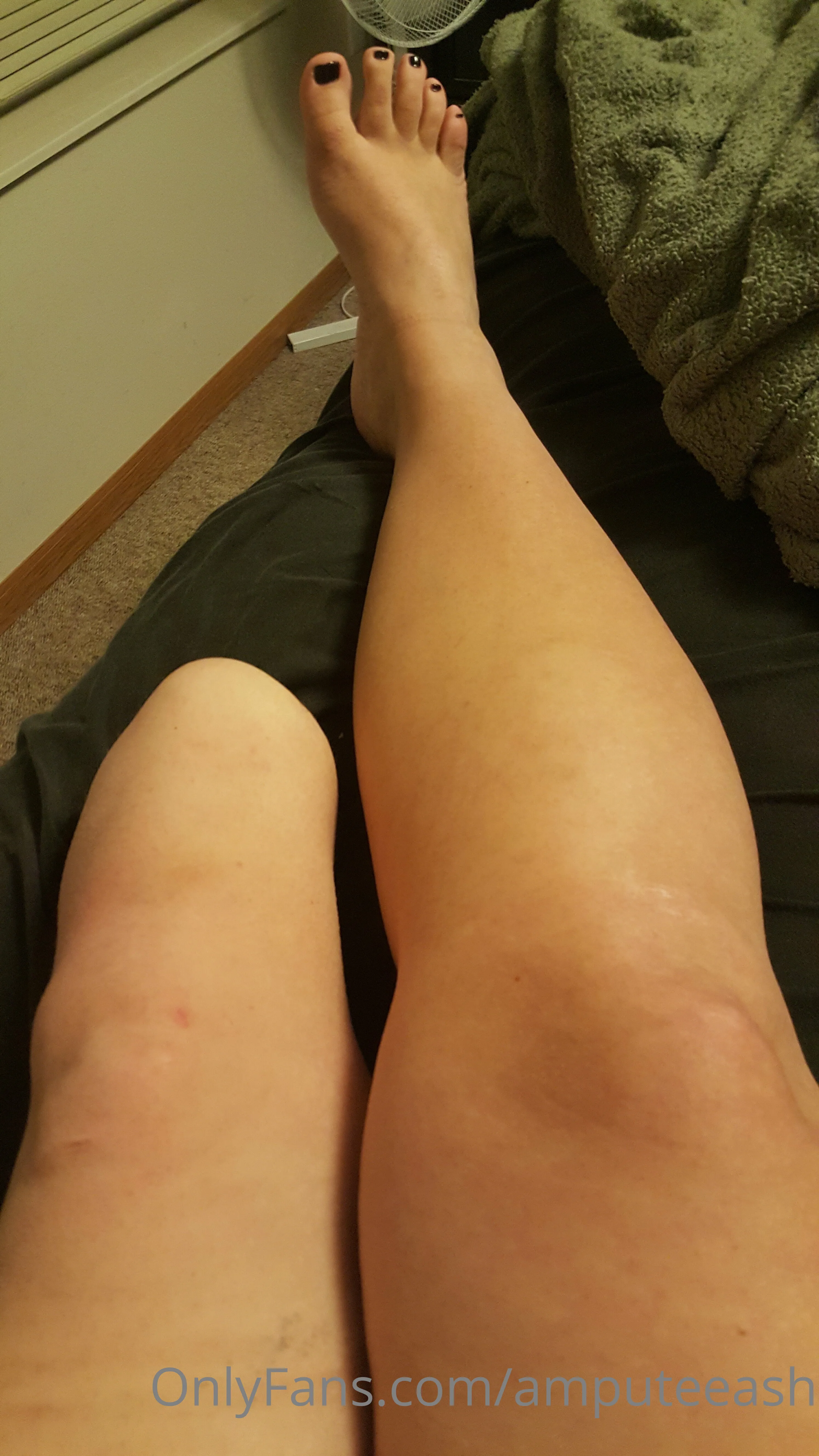 AmputeeAsh OnlyFans leaked nude photo 3 - amputeeash naked pics free download